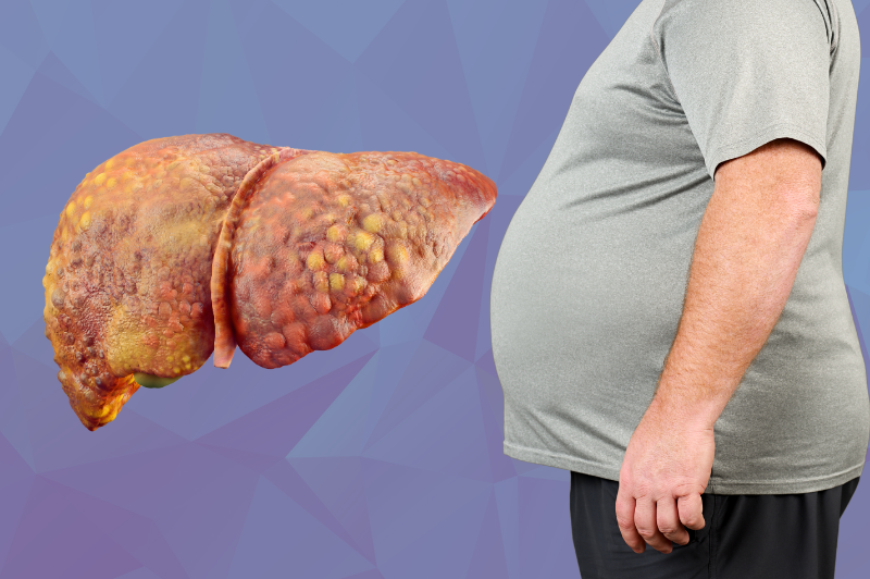 Aprendiendo de un estudio sueco con pacientes con Enfermedad Hepática por Esteatosis Metabólica